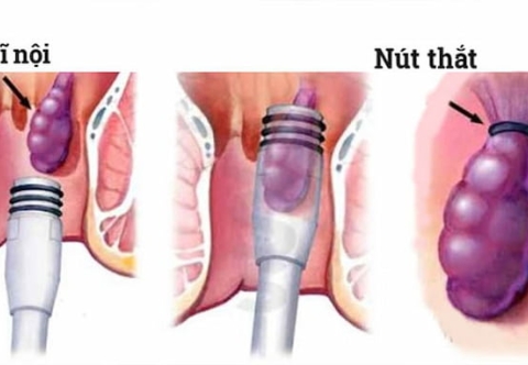 Điều trị bệnh trĩ bằng phương pháp thắt búi trĩ bằng vòng thun